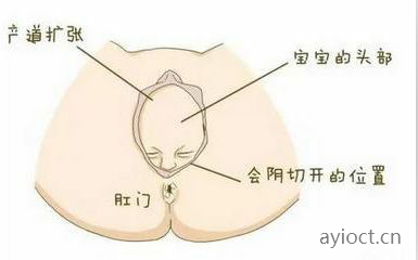 会阴侧切的位置