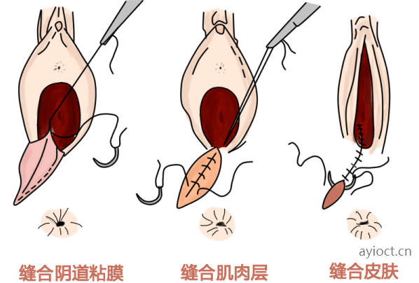 会阴侧切的缝合